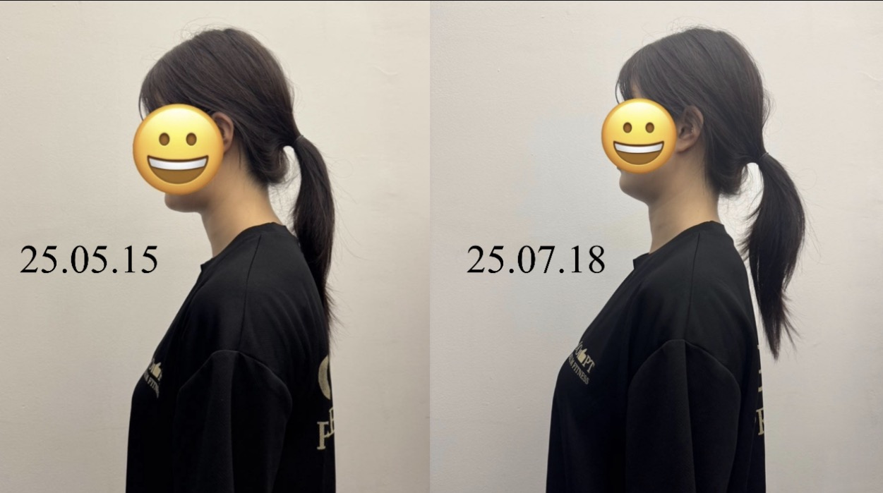 거북목 라운드숄더